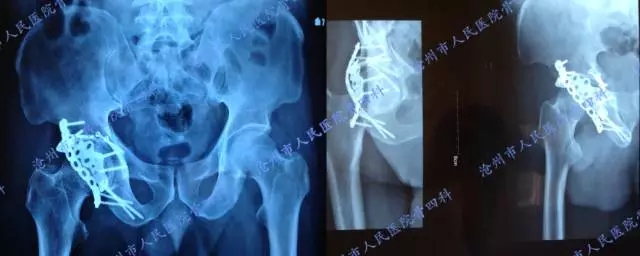 陈旧性髋臼骨折一例