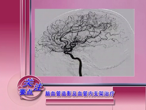 《沧州电视门诊》脑血管造影及血管内支架治疗