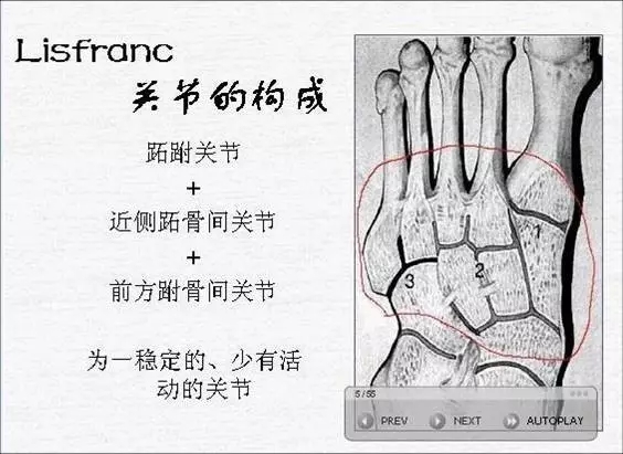 病例分享 Chopart 和lisfranc 损伤 中足骨折与脱位1例骨四科 沧州市人民医院