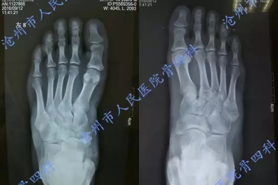 病例分享 Chopart 和lisfranc 损伤 中足骨折与脱位1例骨四科 沧州市人民医院