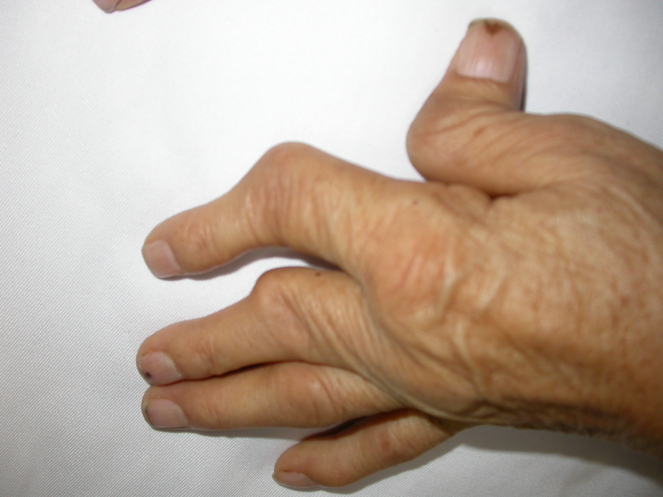 关节外表现为类风湿关节炎病情严重或病变活动的症状,常见的有类风湿